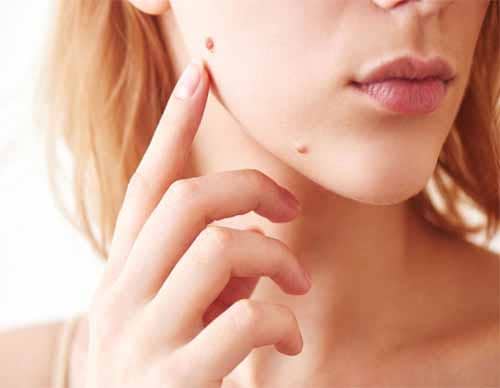 جراحی خال‌های غول‌پیکر